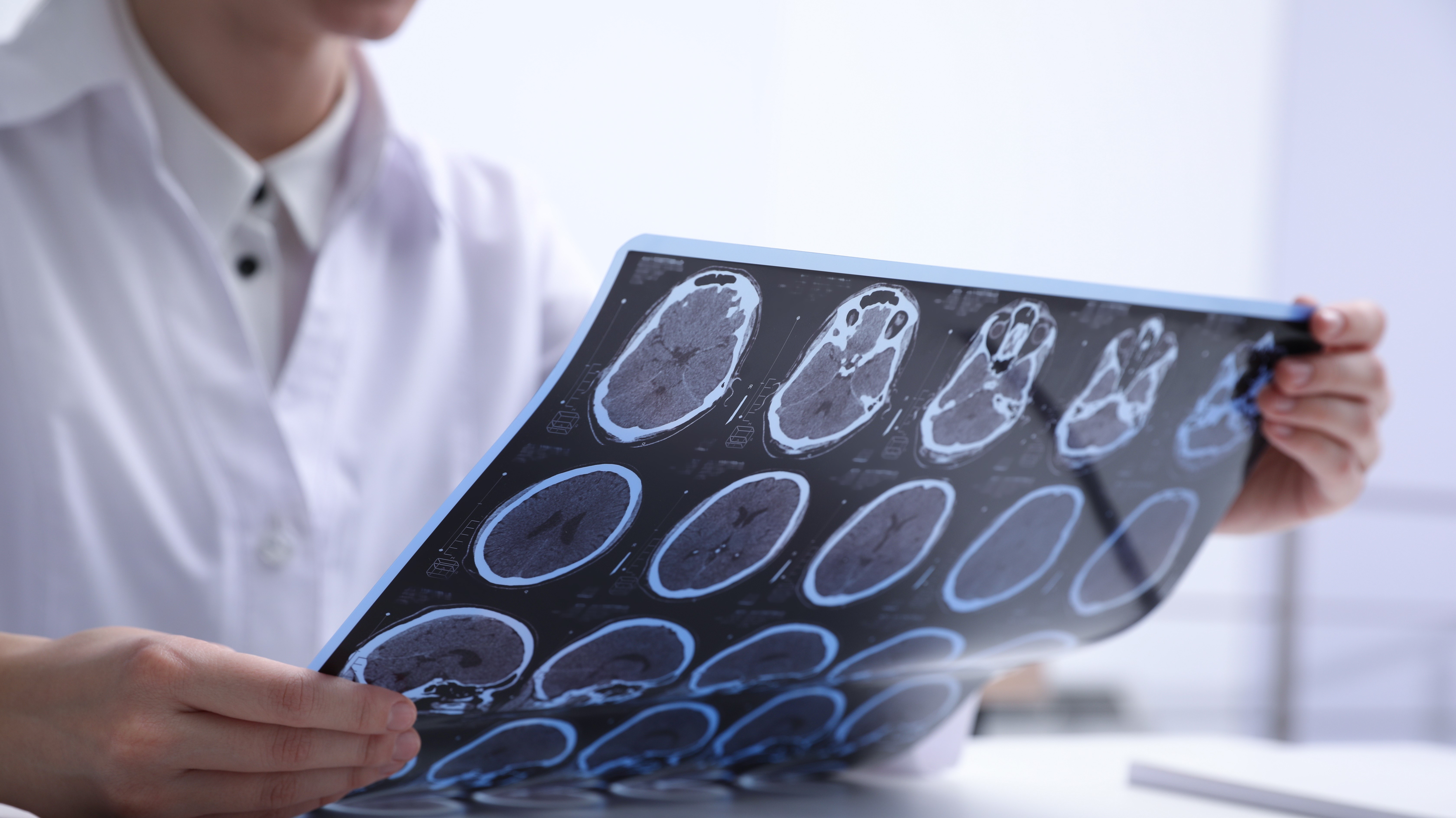 Esclerosis Múltiple